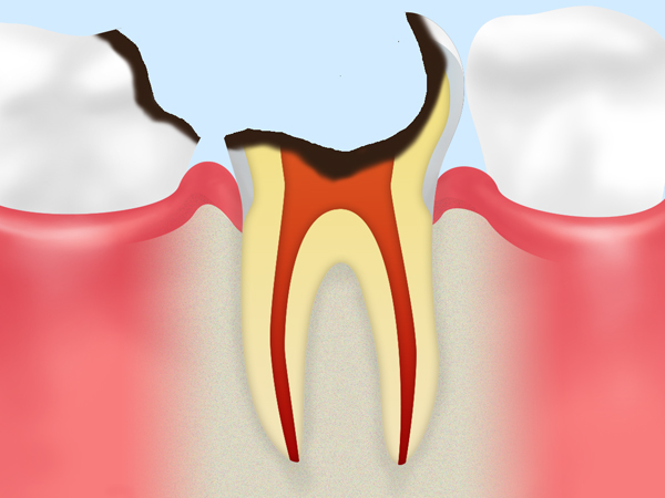 C4　歯根の虫歯