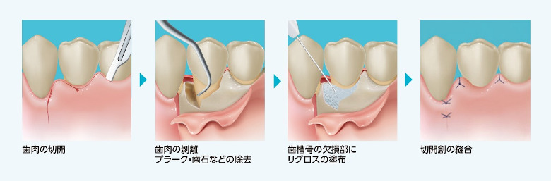 リグロスによる歯周組織再生療法
